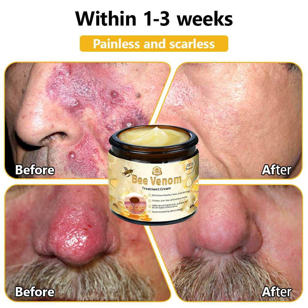 ๐ง๐๐ข๐ฃ๐ยฎ Bee Venom Skin Treatment Cream (FDA Approved๐จโโ๏ธ)๐