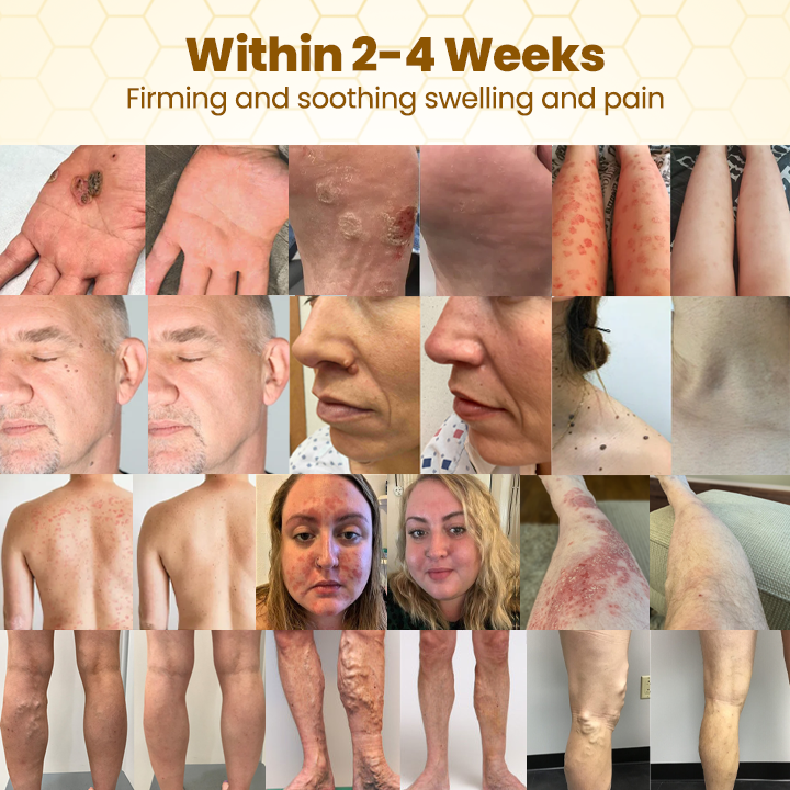 Made and Shipped from USA ✨ 𝗧𝗟𝗢𝗣𝗔® Bee Venom Skin Restoration Cream ⏰