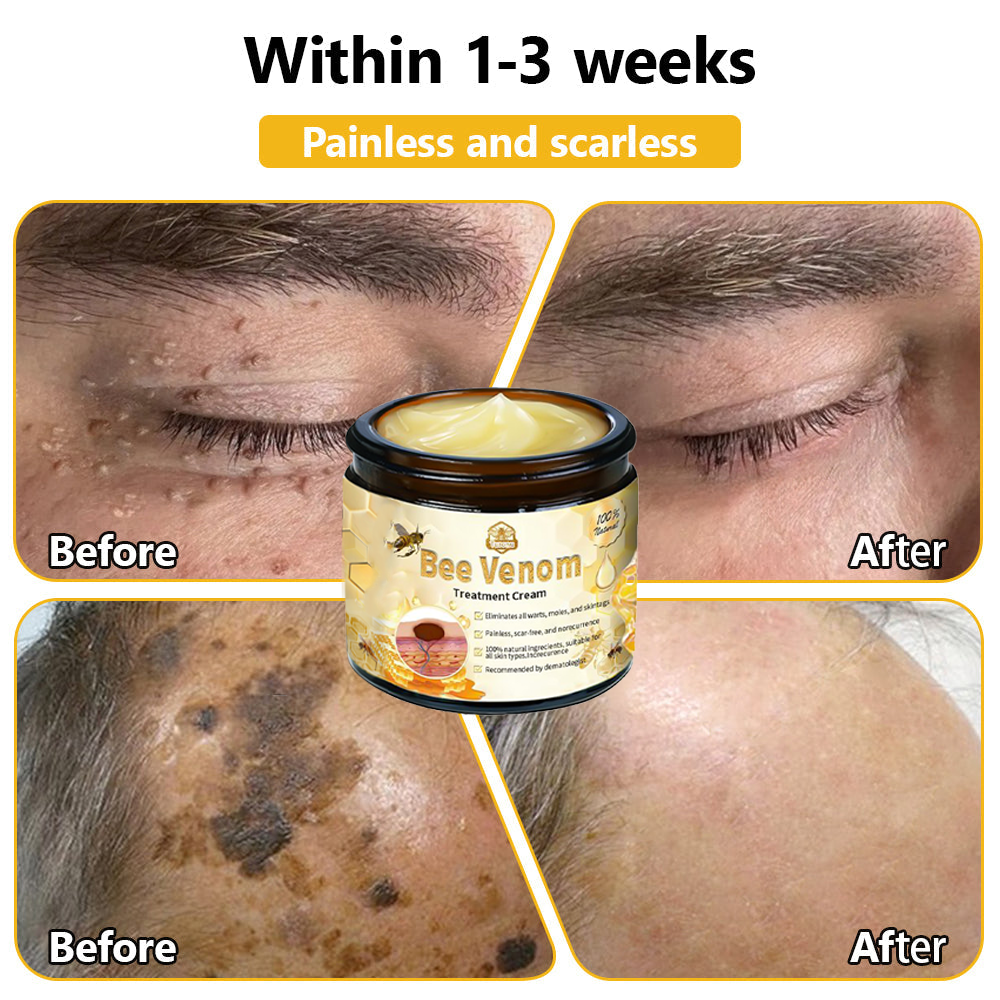 𝗧𝗟𝗢𝗣𝗔® Bee Venom Skin Treatment Cream (FDA Approved👨‍⚕️)💖