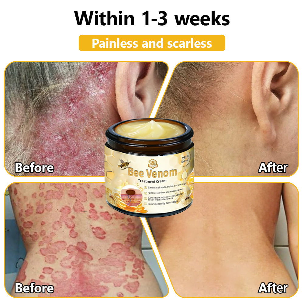 𝗧𝗟𝗢𝗣𝗔® Bee Venom Skin Treatment Cream (FDA Approved👨‍⚕️)💖