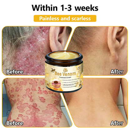𝗧𝗟𝗢𝗣𝗔® Bee Venom Skin Treatment Cream (FDA Approved👨‍⚕️)💖