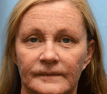 👨‍⚕️ Made and Shipped from USA✅ TLOPA® Botox Bee Venom Wrinkle Removal Cream- LAST DAY 80% OFF